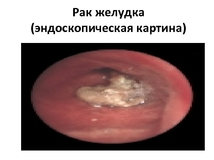 Рак желудка (эндоскопическая картина) 