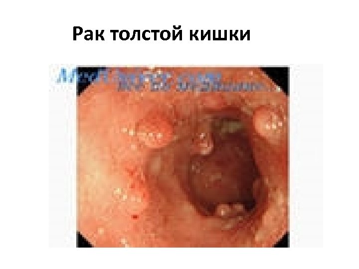 Рак толстой кишки 