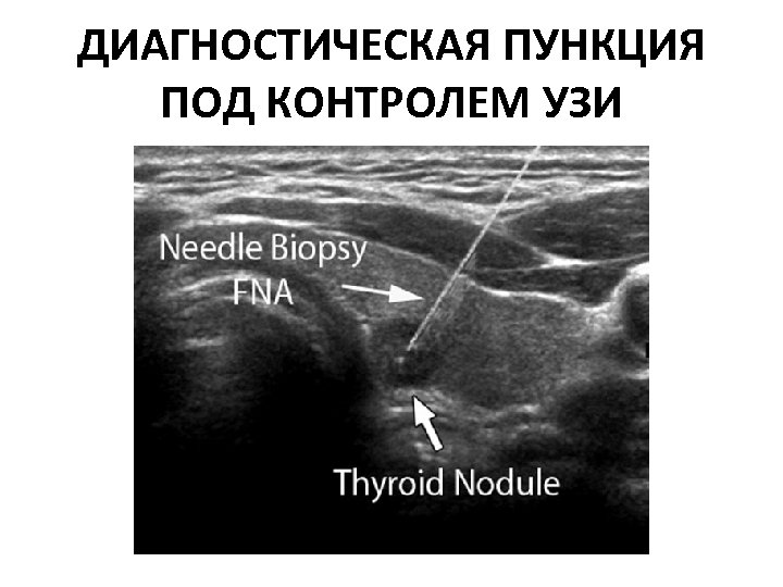 ДИАГНОСТИЧЕСКАЯ ПУНКЦИЯ ПОД КОНТРОЛЕМ УЗИ 