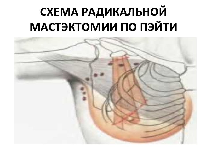 СХЕМА РАДИКАЛЬНОЙ МАСТЭКТОМИИ ПО ПЭЙТИ 