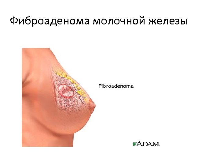 Фиброаденома молочной железы 