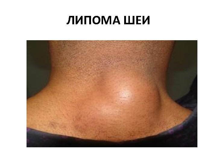 ЛИПОМА ШЕИ 