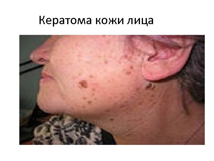 Кератома кожи лица 