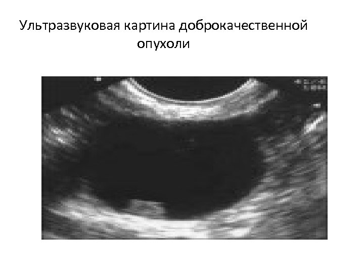 Ультразвуковая картина доброкачественной опухоли 