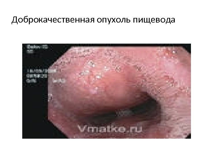 Доброкачественная опухоль пищевода 
