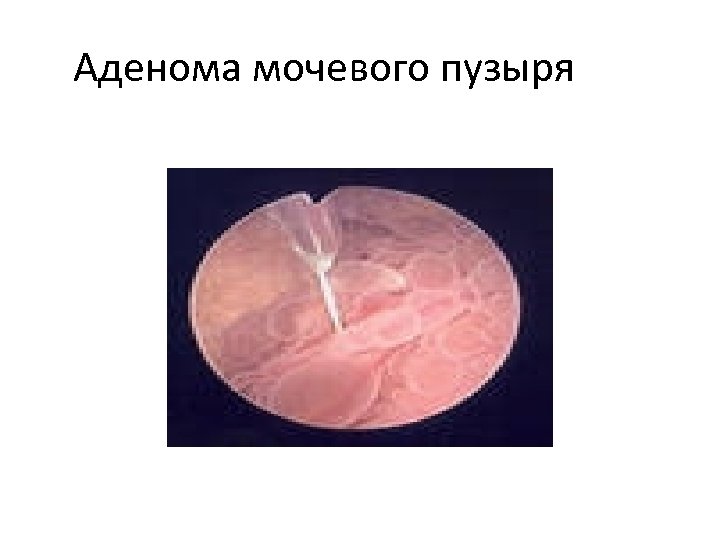 Аденома мочевого пузыря 