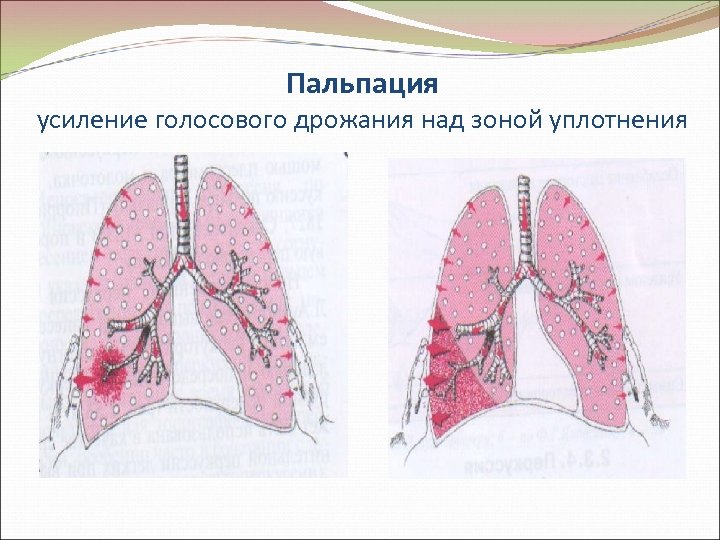 Пальпация усиление голосового дрожания над зоной уплотнения 