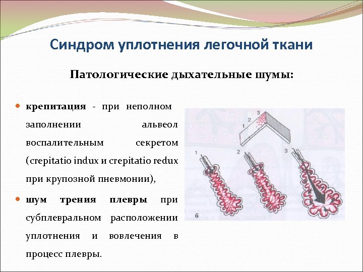 Синдром уплотнения легочной ткани Патологические дыхательные шумы: крепитация - при неполном заполнении альвеол воспалительным