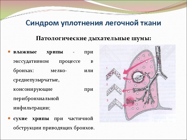 Синдром уплотнения легочной ткани Патологические дыхательные шумы: влажные хрипы экссудативном бронхах: - процессе мелко-