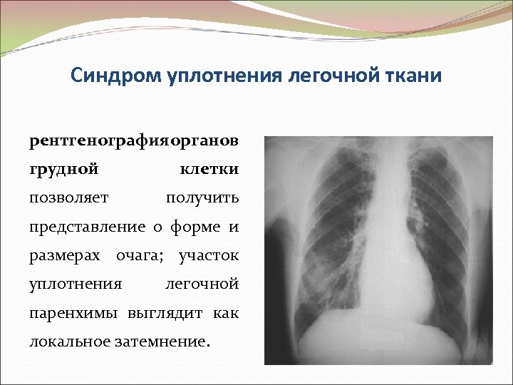 Синдром уплотнения легочной ткани рентгенография органов грудной позволяет клетки получить представление о форме и