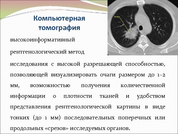 Компьютерная томография высокоинформативный рентгенологический метод исследования с высокой разрешающей способностью, позволяющей визуализировать очаги размером