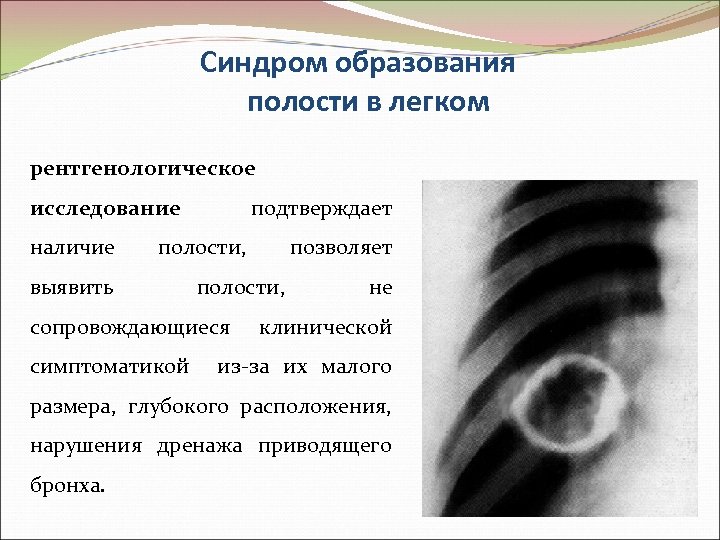 Синдром образования полости в легком рентгенологическое исследование наличие подтверждает полости, выявить полости, сопровождающиеся симптоматикой