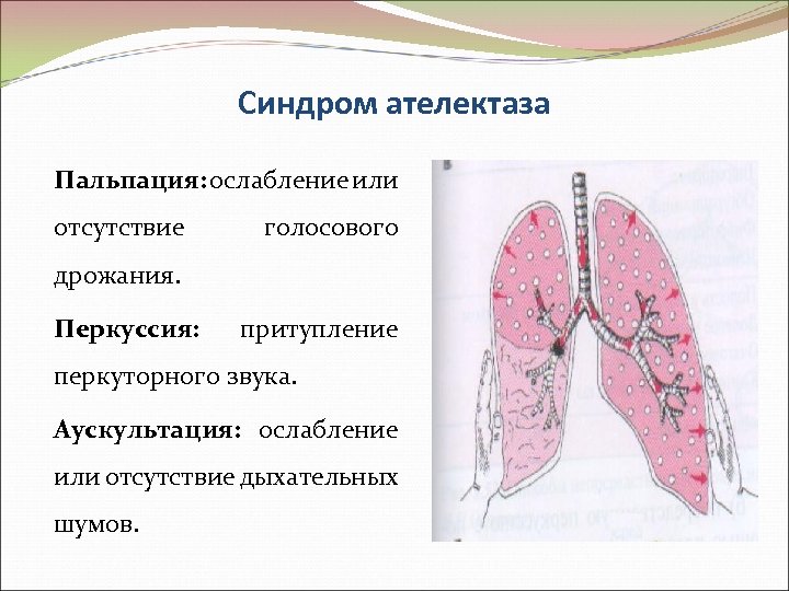 Синдром ателектаза Пальпация: ослабление или отсутствие голосового дрожания. Перкуссия: притупление перкуторного звука. Аускультация: ослабление