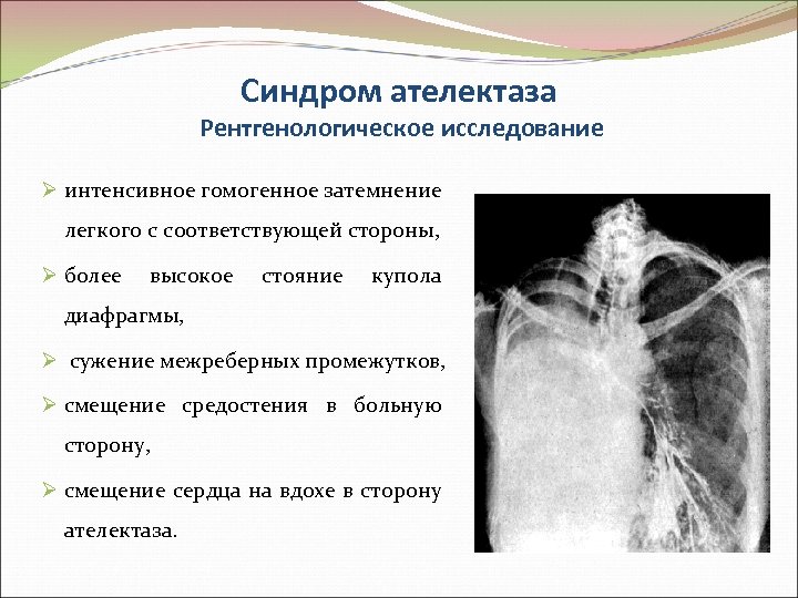 Синдром ателектаза Рентгенологическое исследование Ø интенсивное гомогенное затемнение легкого с соответствующей стороны, Ø более