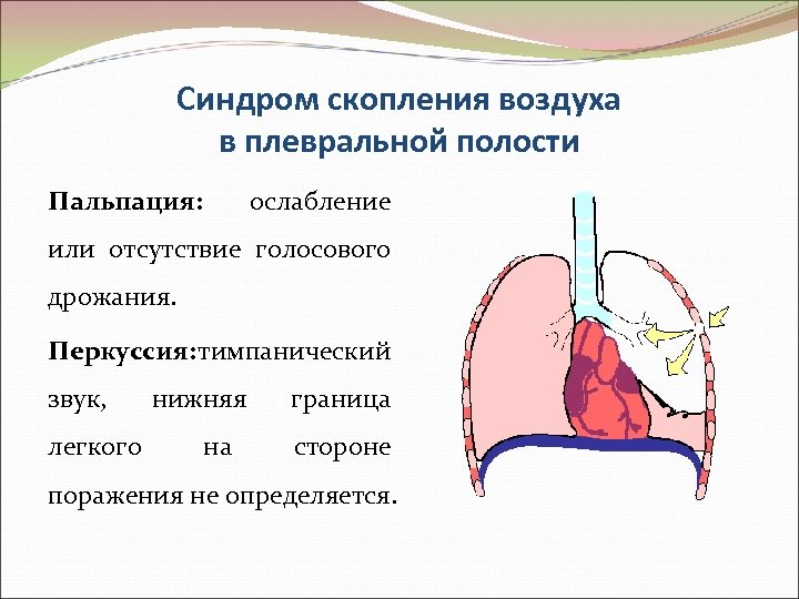 Синдром скопления воздуха в плевральной полости Пальпация: ослабление или отсутствие голосового дрожания. Перкуссия: тимпанический