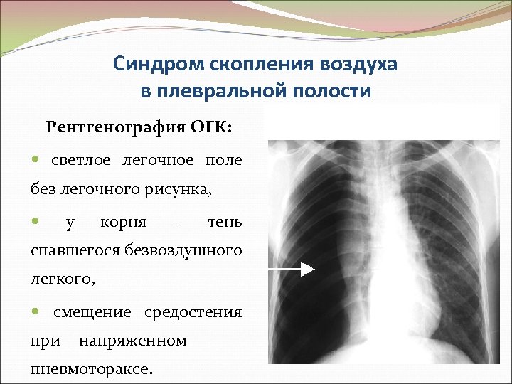 Синдром скопления воздуха в плевральной полости Рентгенография ОГК: светлое легочное поле без легочного рисунка,