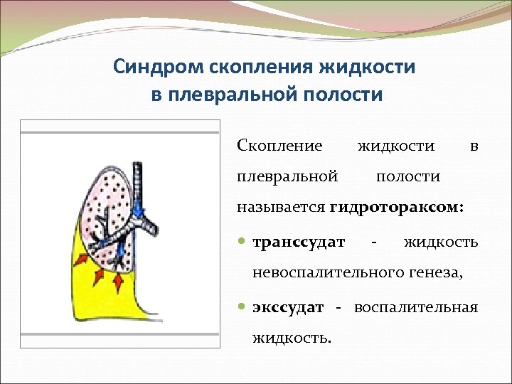 Синдром скопления жидкости в плевральной полости Скопление плевральной жидкости в полости называется гидротораксом: транссудат