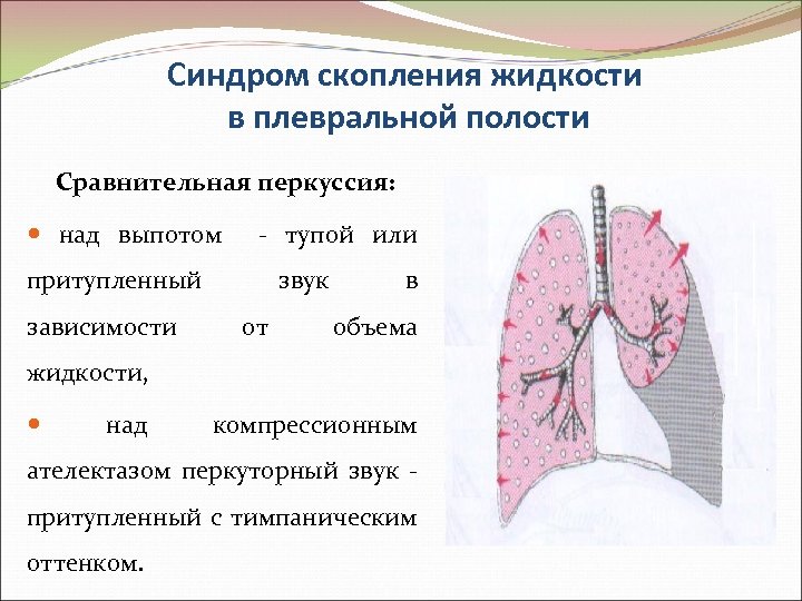 Синдром скопления жидкости в плевральной полости Сравнительная перкуссия: над выпотом - тупой или притупленный