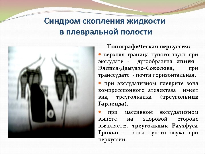 Синдром скопления жидкости в плевральной полости Топографическая перкуссия: верхняя граница тупого звука при экссудате