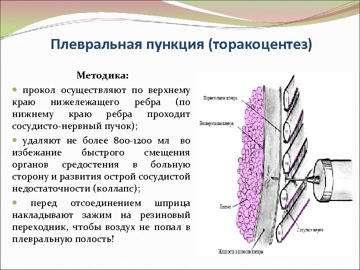 Плевральная пункция (торакоцентез) Методика: прокол осуществляют по верхнему краю нижележащего ребра (по нижнему краю