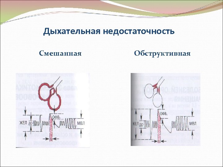 Дыхательная недостаточность Смешанная Обструктивная 