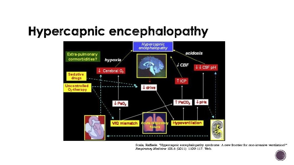 Scala, Raffaele. "Hypercapnic encephalopathy syndrome: A new frontier for non-invasive ventilation? " Respiratory Medicine