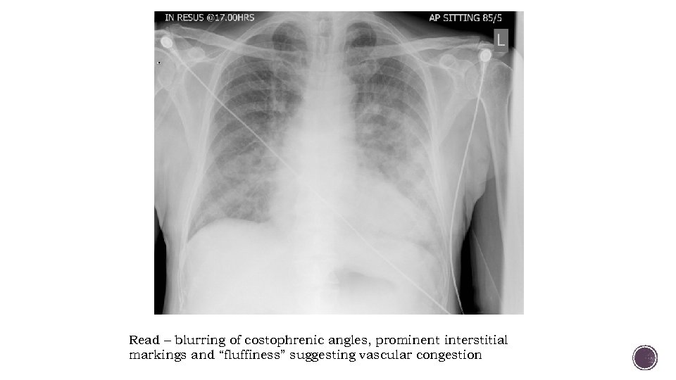 Read – blurring of costophrenic angles, prominent interstitial markings and “fluffiness” suggesting vascular congestion