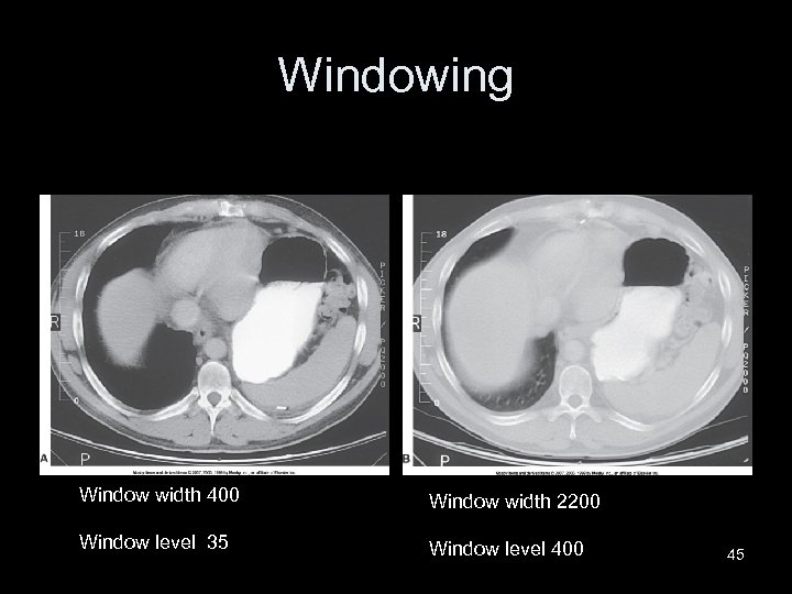 Windowing Window width 400 Window width 2200 Window level 35 Window level 400 45