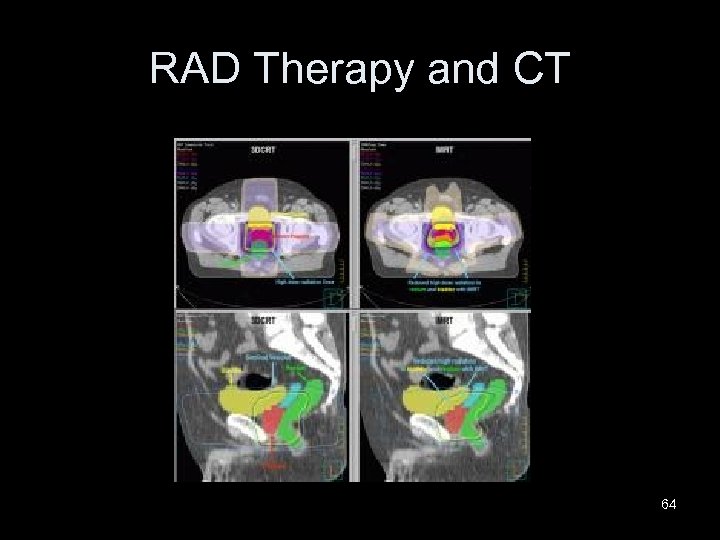 RAD Therapy and CT 64 