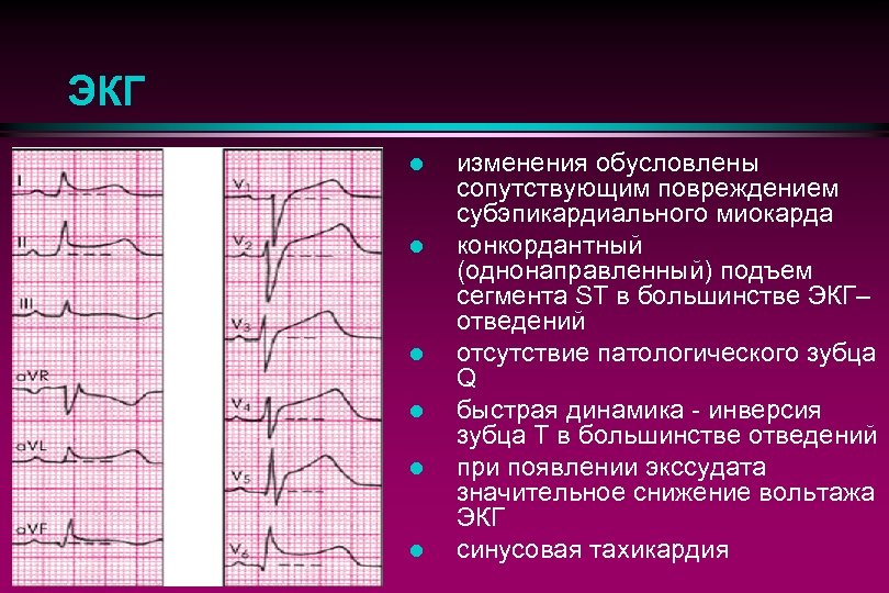 Конкордантный подъем st. Отрицательные зубцы ЭКГ. Изменения на ЭКГ при инсульте. Экссудативный перикардит ЭКГ. Конкордантный подъем сегмента St – характерный признак.