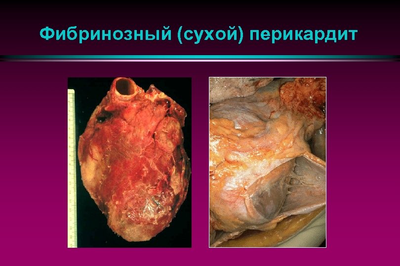 Фибринозный (сухой) перикардит 