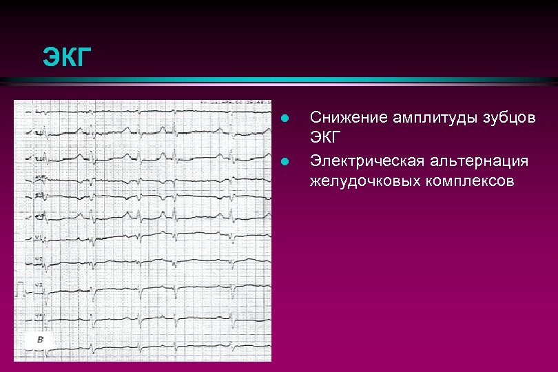 ЭКГ l l Снижение амплитуды зубцов ЭКГ Электрическая альтернация желудочковых комплексов 
