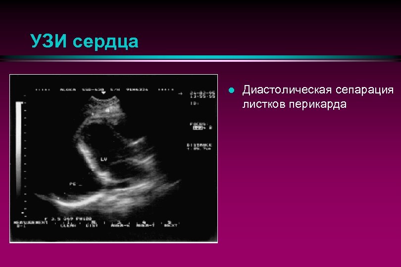 УЗИ сердца l Диастолическая сепарация листков перикарда 