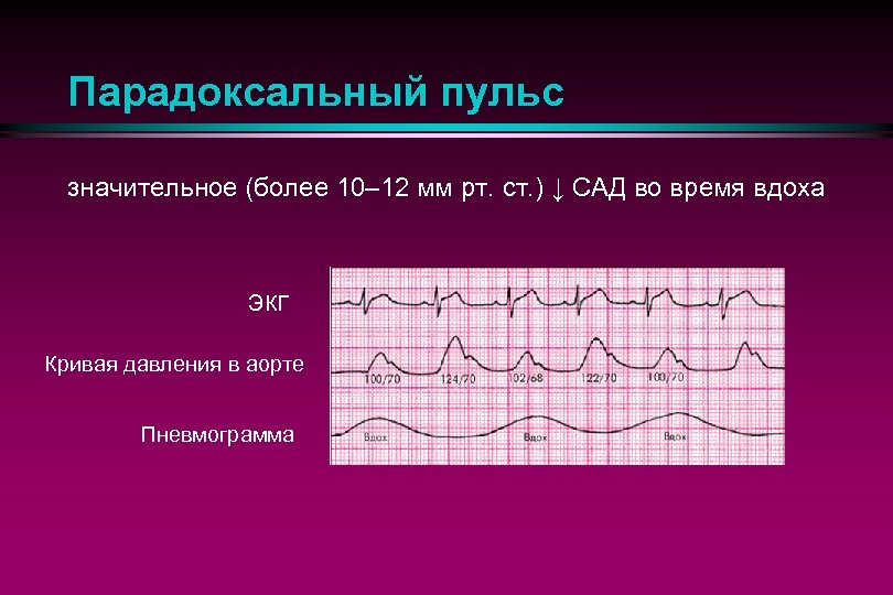 Парадоксальный пульс значительное (более 10– 12 мм рт. ст. ) ↓ САД во время