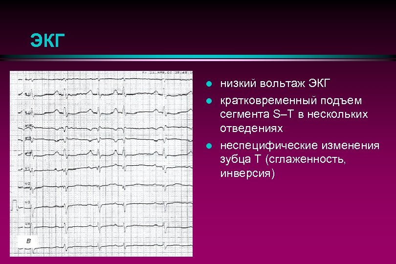 ЭКГ l l l низкий вольтаж ЭКГ кратковременный подъем сегмента S–Т в нескольких отведениях