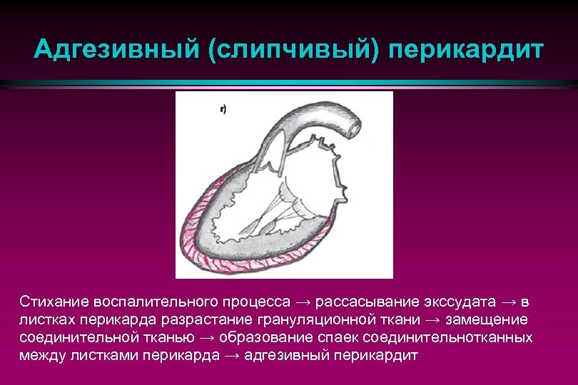 Адгезивный (слипчивый) перикардит Стихание воспалительного процесса → рассасывание экссудата → в листках перикарда разрастание