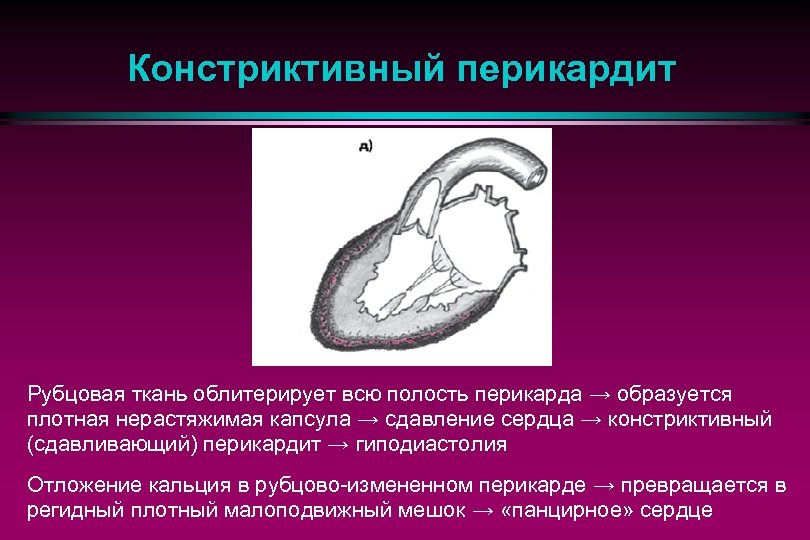 Констриктивный перикардит Рубцовая ткань облитерирует всю полость перикарда → образуется плотная нерастяжимая капсула →