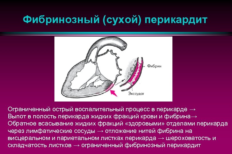 Перикард что это простыми словами. Острый фибринозный перикардит этиология. Острый перикардит эхокардиография. Фибринозный перикардит патогенез. Фибринозный периостит.