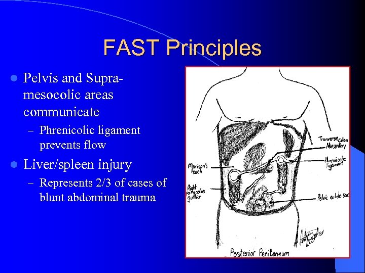 FAST Principles l Pelvis and Supramesocolic areas communicate – Phrenicolic ligament prevents flow l