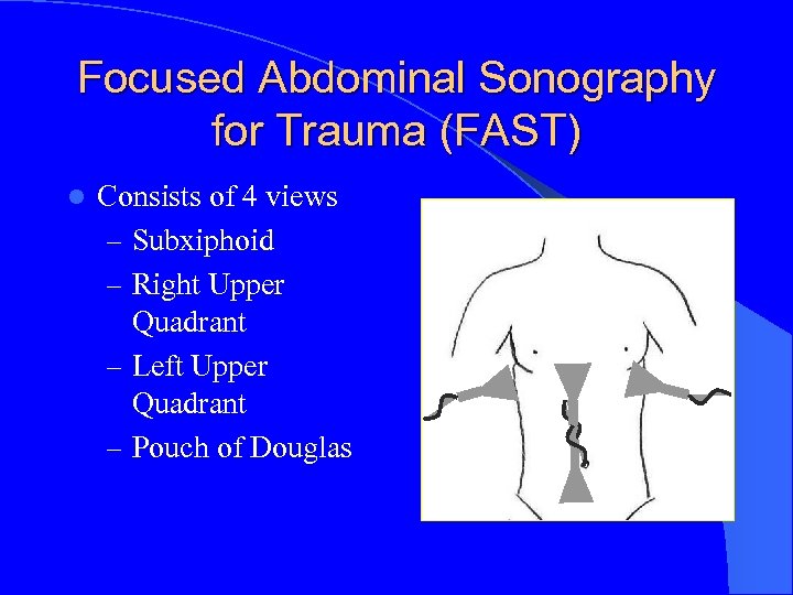 Focused Abdominal Sonography for Trauma (FAST) l Consists of 4 views – Subxiphoid –