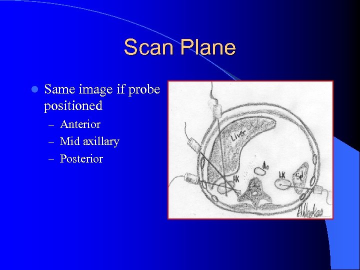 Scan Plane l Same image if probe positioned – Anterior – Mid axillary –