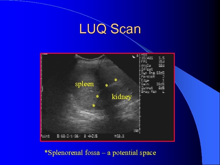 LUQ Scan spleen * * * kidney * *Splenorenal fossa – a potential space