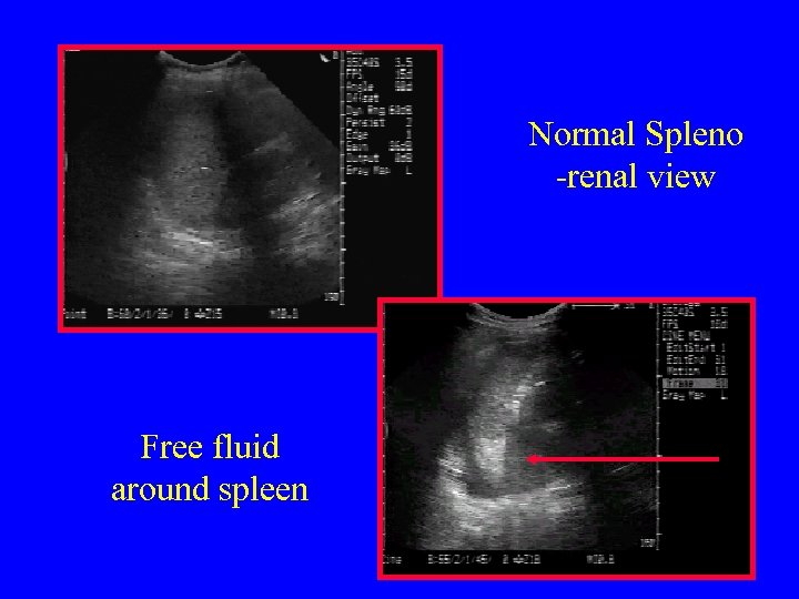 Normal Spleno -renal view Free fluid around spleen 