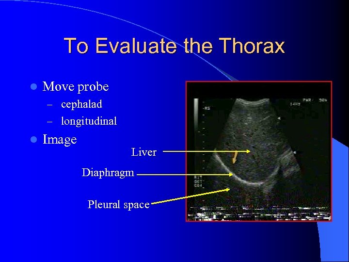To Evaluate the Thorax l Move probe – cephalad – longitudinal l Image Liver