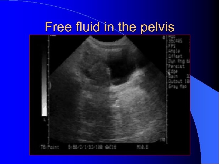 Free fluid in the pelvis 