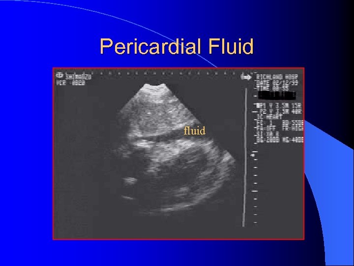 Pericardial Fluid fluid 