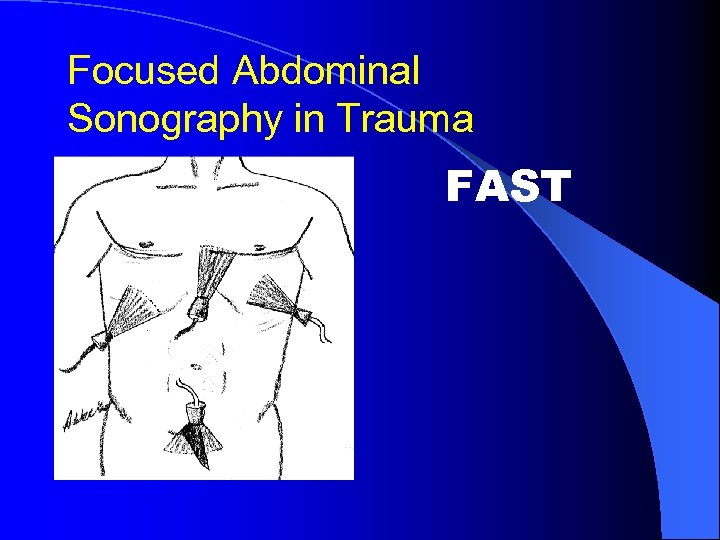 Focused Abdominal Sonography in Trauma FAST 