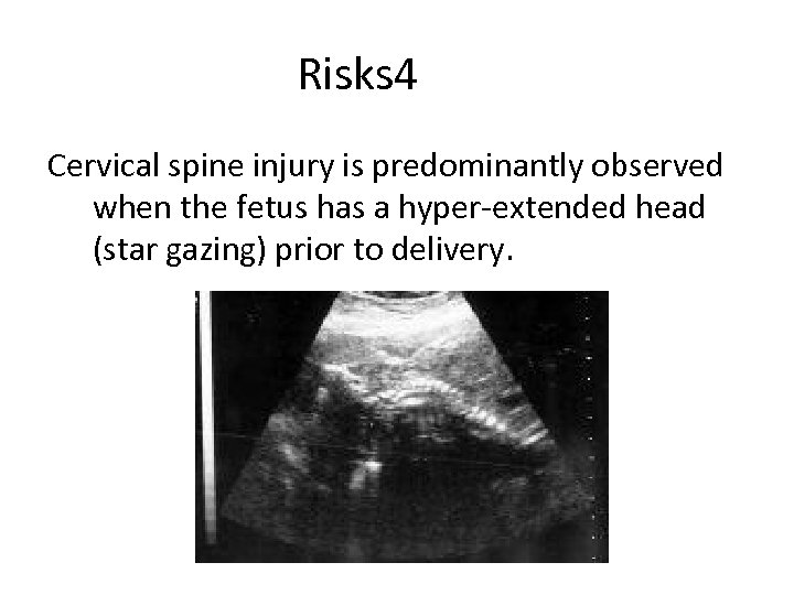 Risks 4 Cervical spine injury is predominantly observed when the fetus has a hyper-extended