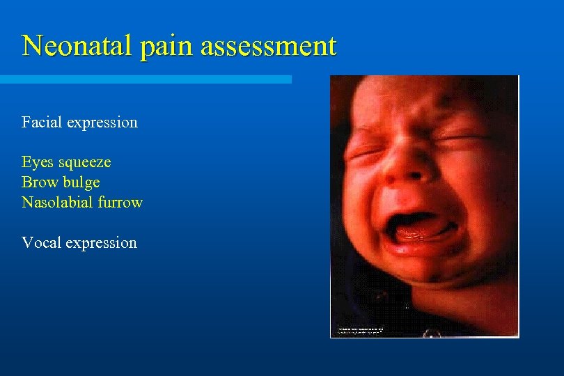 Neonatal pain assessment Facial expression Eyes squeeze Brow bulge Nasolabial furrow Vocal expression 