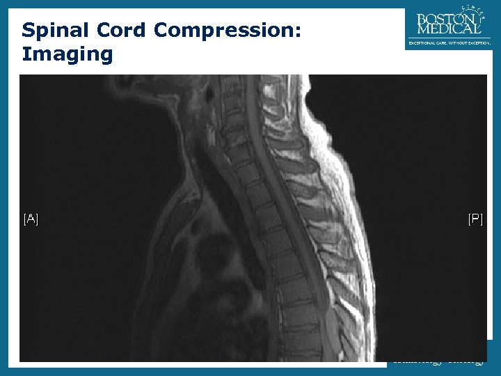 Spinal Cord Compression: Imaging 14 • MRI vs Myelography • 33% will have multiple